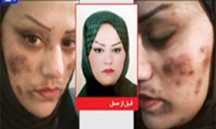 اکسیر جوانی، زیبایی یک زن را گرفت+عکس اکسیر جوانی، زیبایی یک زن را گرفت+عکس