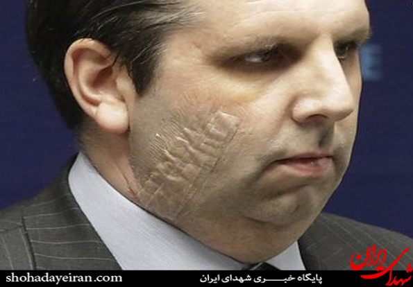 عکس/صورت سفیر آمریکا پس از ۸۰ بخیه عکس/صورت سفیر آمریکا پس از ۸۰ بخیه