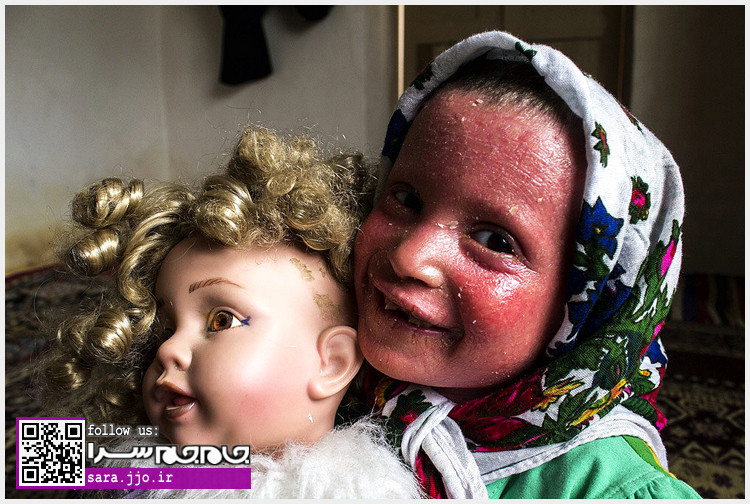 دختر بچهای با یک بیماری پوستی دردآور + تصاویر دختر بچهای با یک بیماری پوستی دردآور + تصاویر