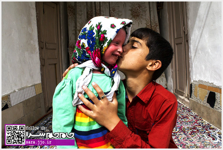 دختر بچهای با یک بیماری پوستی دردآور + تصاویر دختر بچهای با یک بیماری پوستی دردآور + تصاویر