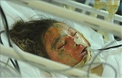 مرگ تلخ دو کودک بر اثر واژگونی دیگ آبجوش مرگ تلخ دو کودک بر اثر واژگونی دیگ آبجوش