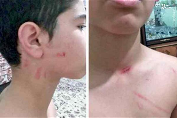 تنبیه شدید بدنی دانشآموز ابتدایی در مدرسه+عکس تنبیه شدید بدنی دانشآموز ابتدایی در مدرسه+عکس