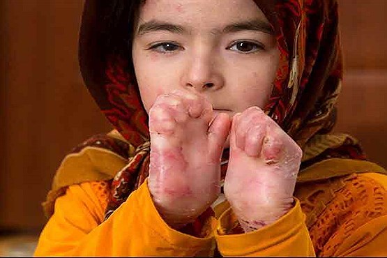 زخم پروانههای کوچک در جستجوی مرهم+عکس زخم پروانههای کوچک در جستجوی مرهم+عکس