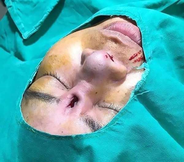 عاقبت وحشتناک جراحی بینی در یک کلینیک +عکس عاقبت وحشتناک جراحی بینی در یک کلینیک +عکس