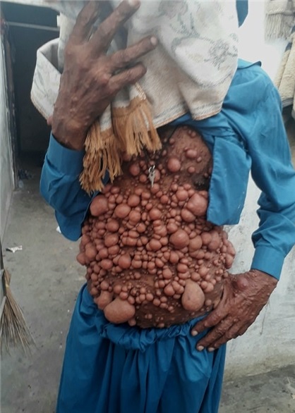 بیماری عجیب مردپاکستانی+تصاویر بیماری عجیب مردپاکستانی+تصاویر