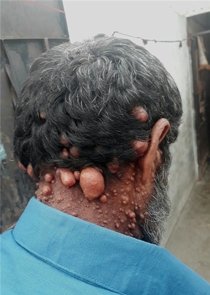 بیماری عجیب مردپاکستانی+تصاویر بیماری عجیب مردپاکستانی+تصاویر