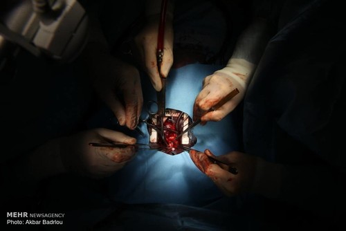 جراحی قلب کودک 15 ماهه در بیمارستان شهید مدرس جراحی قلب کودک 15 ماهه در بیمارستان شهید مدرس