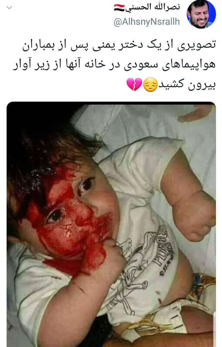 دختر یمنی پس از بمباران هواپیماهای سعودی