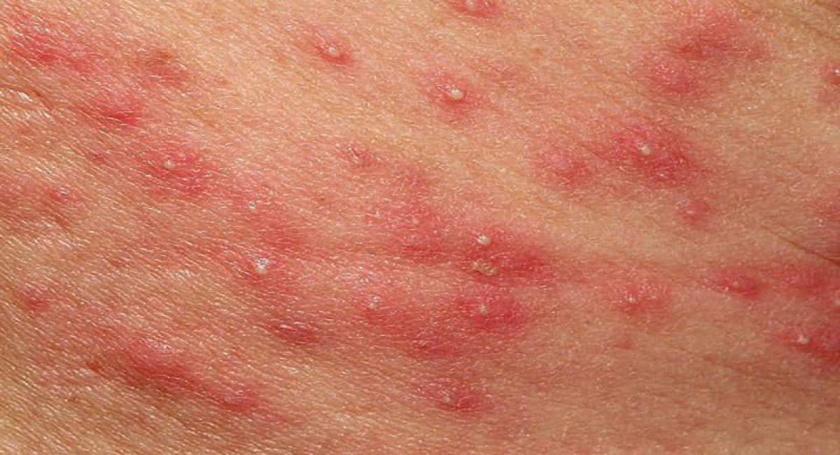 علت جوش چرکی و درمان خانگی آن چیست ؟